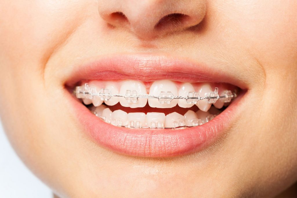 Diş Teli Ağrınızı Azaltacak 10 İpucu
